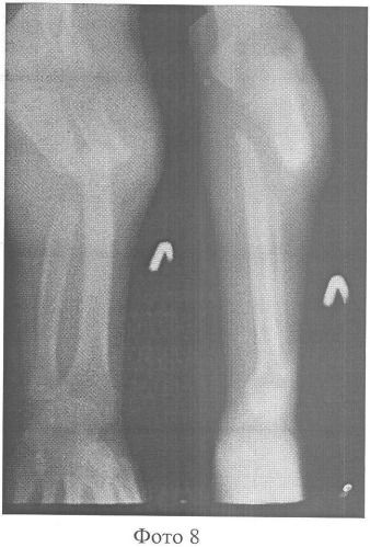 Способ хирургического лечения сегментарных дефектов диафизов костей предплечья (патент 2358677)