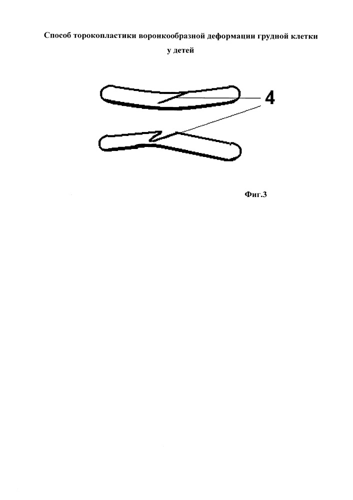 Способ торокопластики воронкообразной деформации грудной клетки (патент 2653264)
