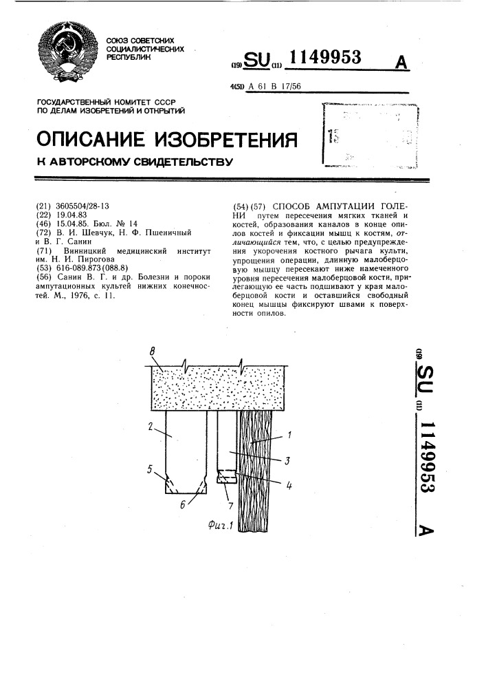 Способ ампутации голени (патент 1149953)