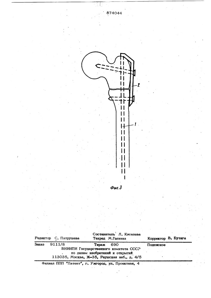 Устройство для фиксации фрагментов трубчатых костей (патент 874044)