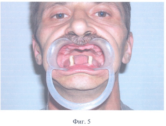 Полный съемный зубной протез верхней челюсти (патент 2314773)