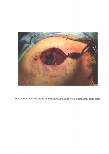 Способ профилактики экструзии силиконового имплантата после кожесохраняющей мастэктомии (патент 2591784)