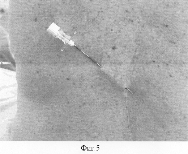 Безопасный способ постановки эпидурального катетера в &quot;туннеле&quot; для продленной аналгезии (патент 2301083)