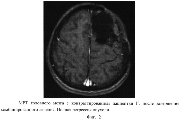 Способ термохимиолучевого лечения злокачественных глиом головного мозга (патент 2567836)