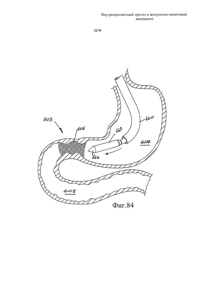 Внутрипросветный протез и желудочно-кишечный имплантат (патент 2626885)