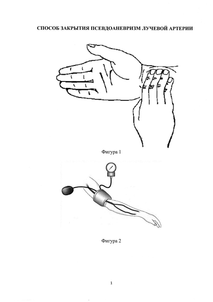 Способ закрытия псевдоаневризм лучевой артерии (патент 2622602)