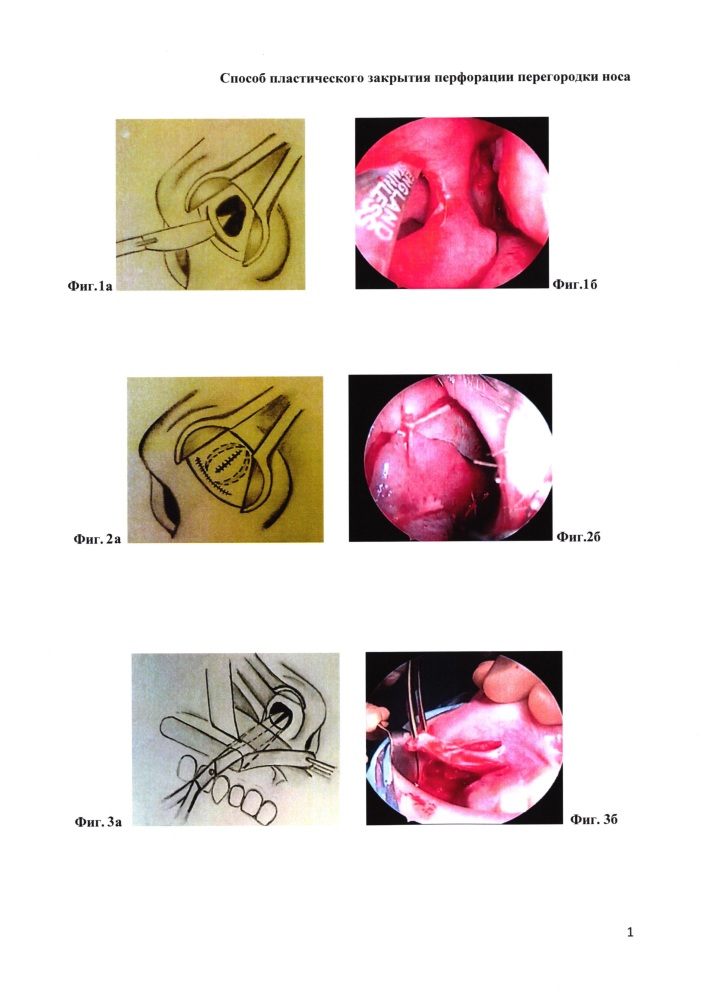 Способ пластического закрытия перфорации перегородки носа у детей (патент 2615906)