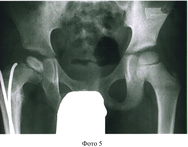 Способ хирургического лечения болезни пертеса у детей (патент 2552701)