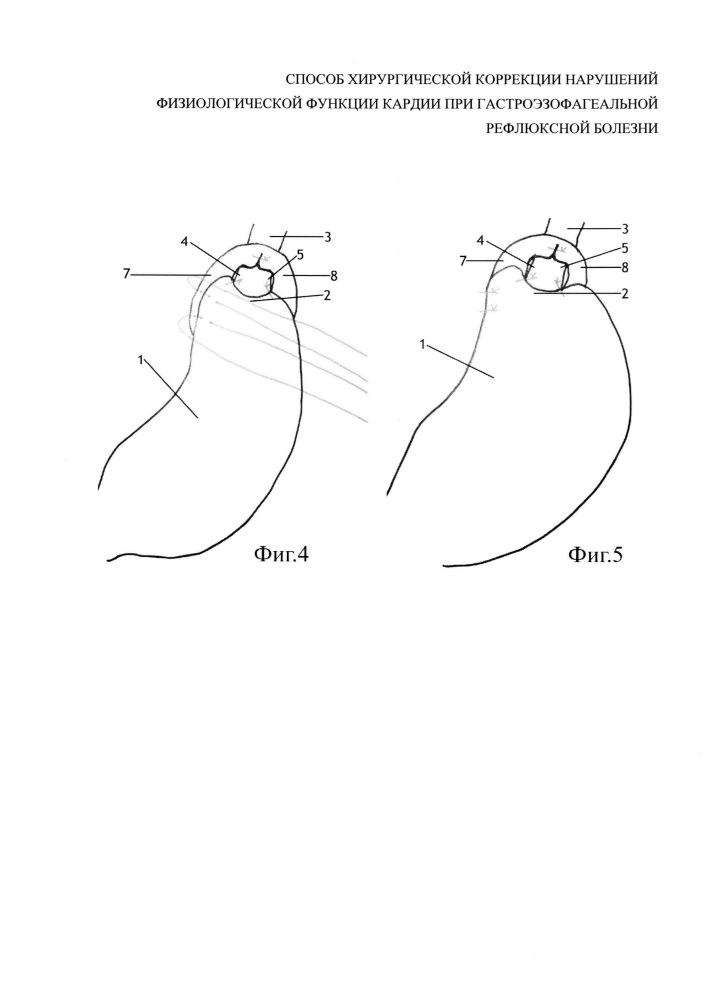 Способ хирургической коррекции нарушений физиологической функции кардии при гастроэзофагеальной рефлюксной болезни (патент 2641064)