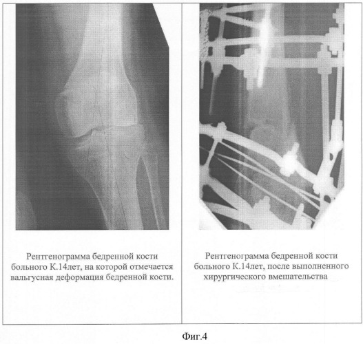 Способ устранения вальгусной (варусной) деформации бедренной кости (патент 2347540)