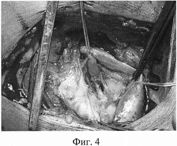 Способ лечения вторичных лимфедем нижних конечностей ii-iii стадии (патент 2570612)