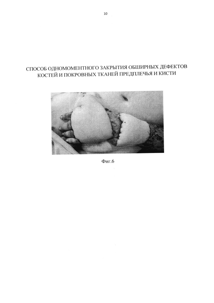 Способ одномоментного закрытия обширных дефектов костей и покровных тканей предплечья и кисти (патент 2645973)