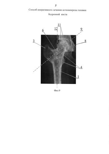Способ оперативного лечения остеонекроза головки бедренной кости (патент 2578833)