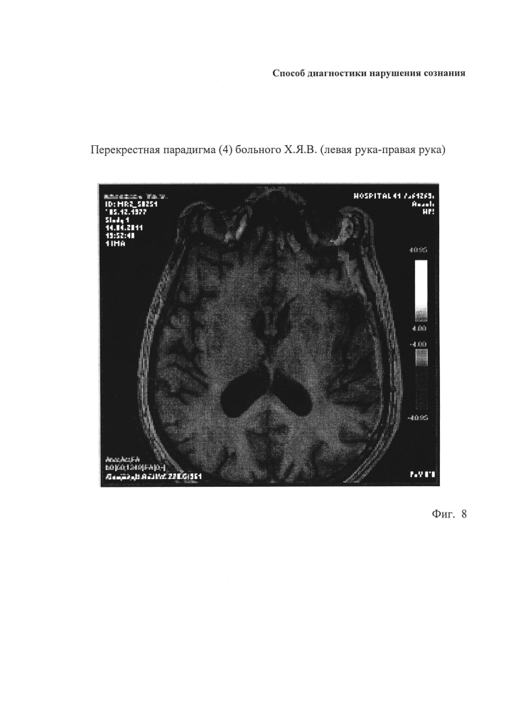 Способ диагностики нарушения сознания (патент 2596049)