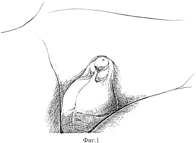 Способ высвобождения кавернозных и спонгиозного тел и удлинения видимой части ствола полового члена (патент 2350284)