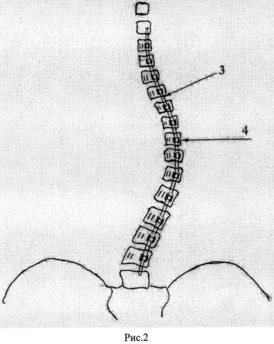 Способ коррекции идиопатического сколиоза позвоночника грудопоясничной локализации у детей (патент 2562511)