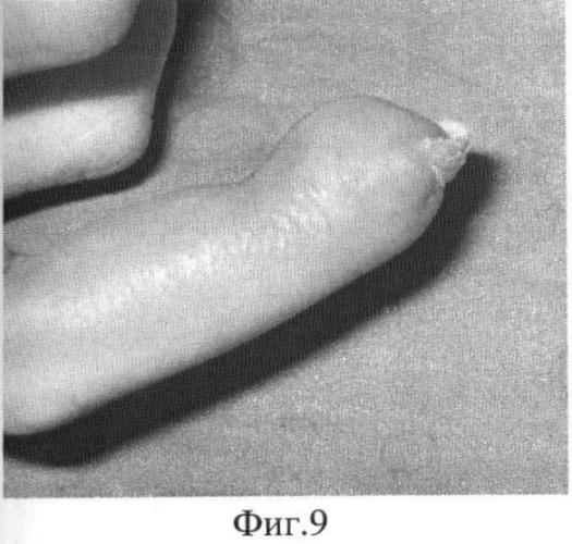 Способ реконструкции ногтевой фаланги пальца кисти при когтевидной деформации (патент 2397717)