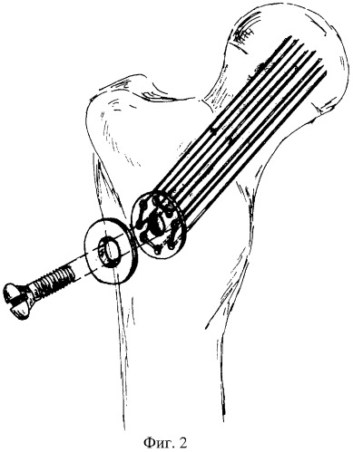 Способ оперативного лечения медиальных переломов шейки бедренной кости (патент 2284783)