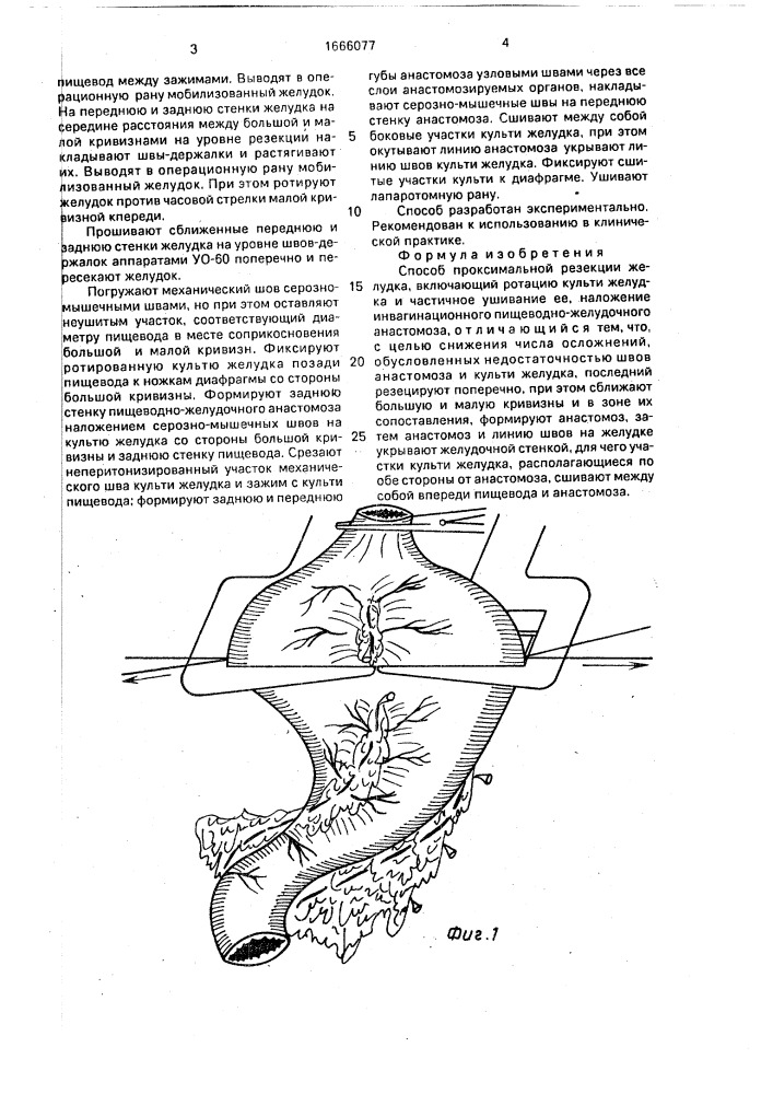 Способ проксимальной резекции желудка (патент 1666077)