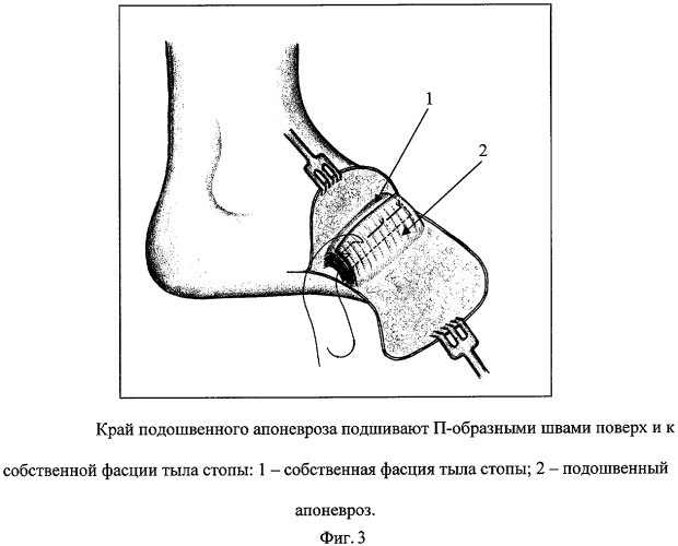 Туалет культи