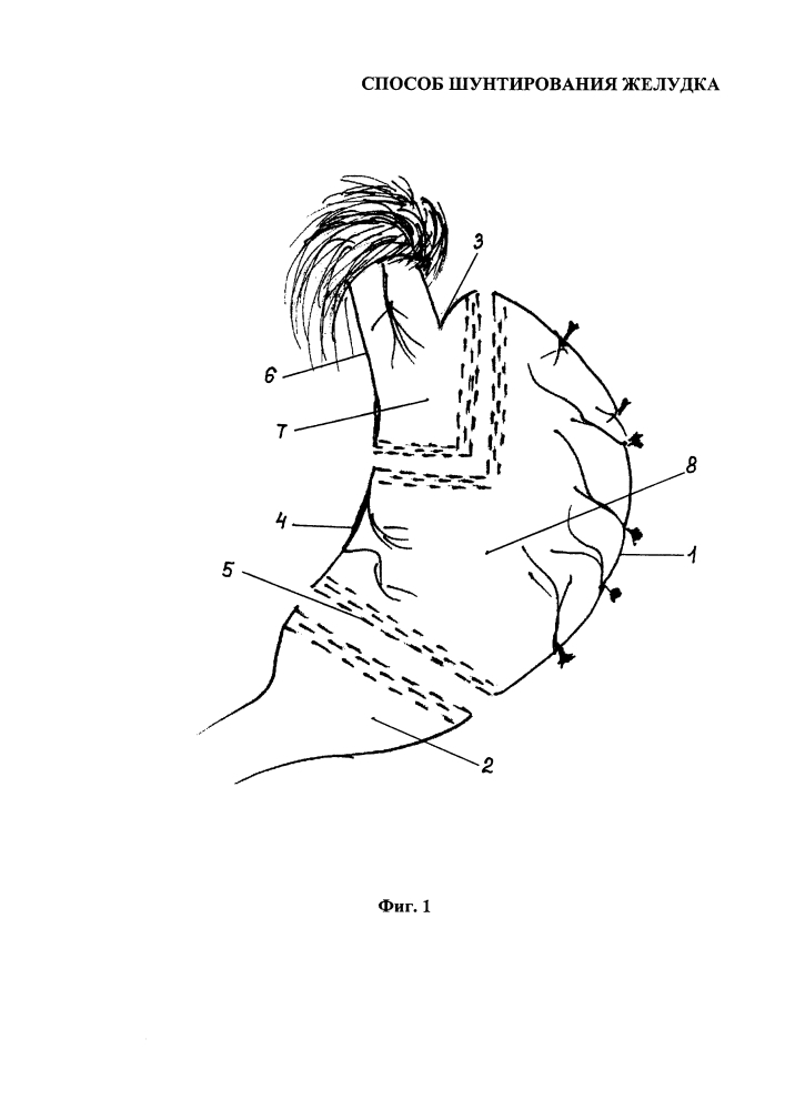 Способ шунтирования желудка (патент 2616988)
