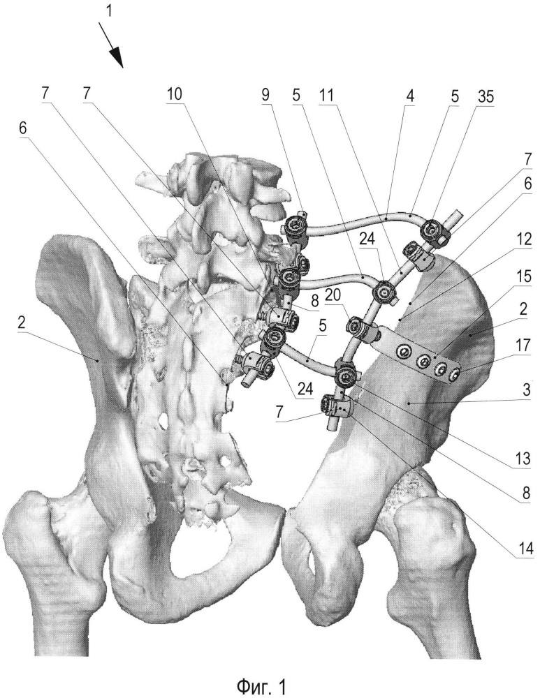 Устройство для реконструкции костей таза (патент 2626122)