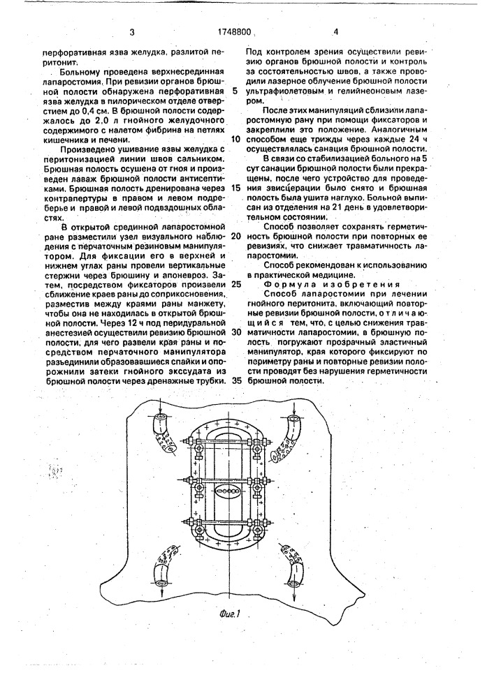 Способ лапаростомии при лечении гнойного перитонита (патент 1748800)