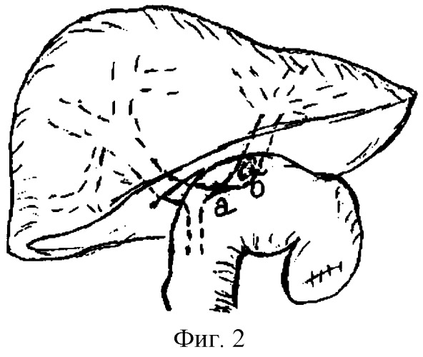 Способ рационального выделения левого долевого печеночного протока для анастомоза с тонкой кишкой (патент 2245110)