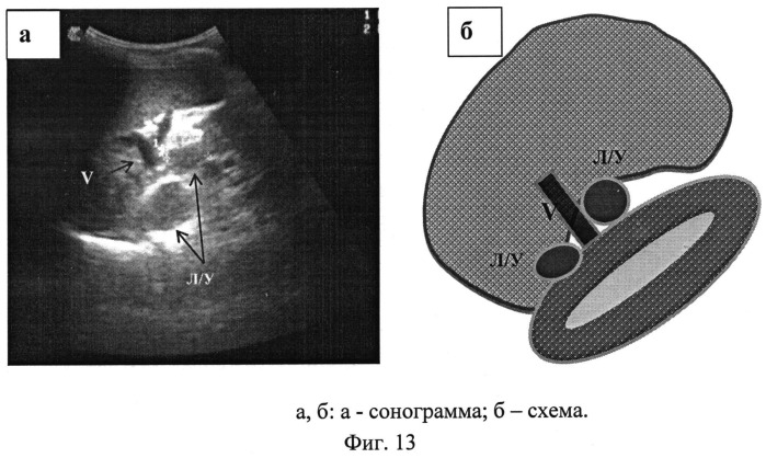 Способ ультразвуковой диагностики воспалительных изменений печени и селезенки при туберкулезе у детей (патент 2535613)