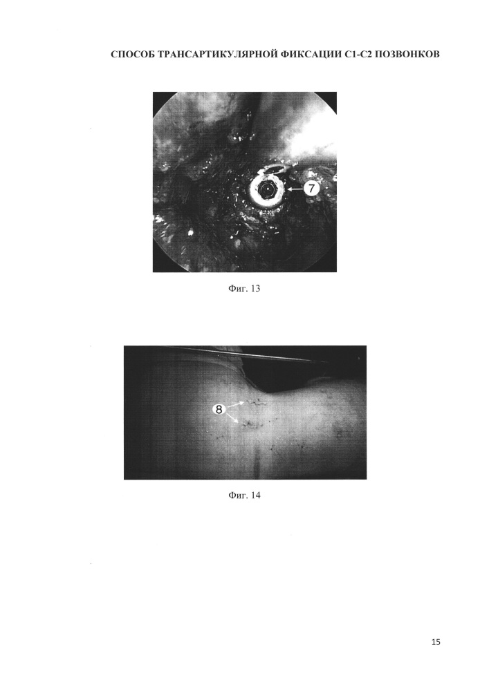 Способ выполнения трансартикулярной фиксации с1-с2 позвонков (патент 2662203)