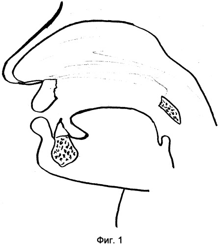 Способ реконструкции верхней челюсти (патент 2341215)