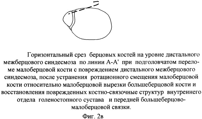 Способ оперативного лечения подголовчатых переломов малоберцовой кости при переломовывихах в голеностопном суставе (патент 2369341)