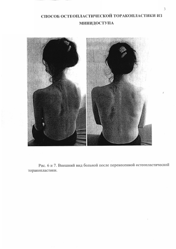 Способ остеопластической торакопластики из минидоступа (патент 2587315)