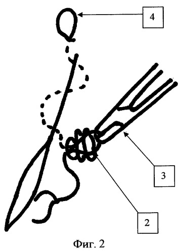 Внутрикожный шов (патент 2270620)