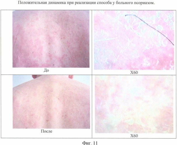 Способ фотоиммунотерапии фотосенсибилизатором, активируемым волновой энергией вне организма человека (патент 2345803)