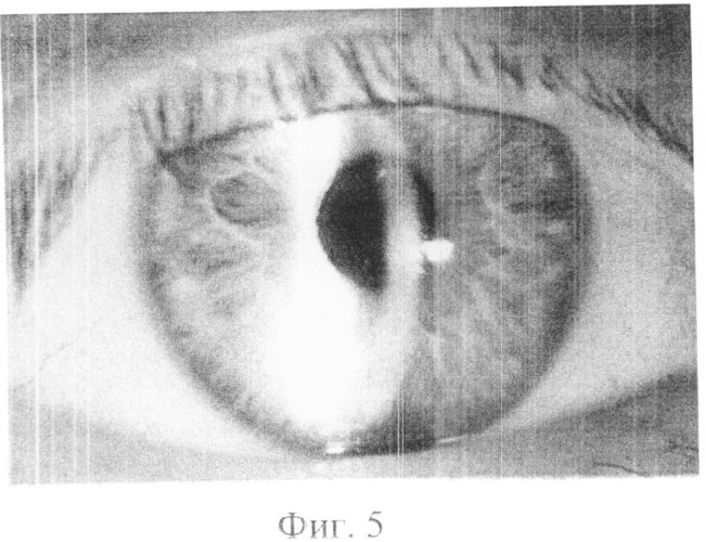 Способ лечения воспалительных состояний переднего отрезка глаза (патент 2513597)
