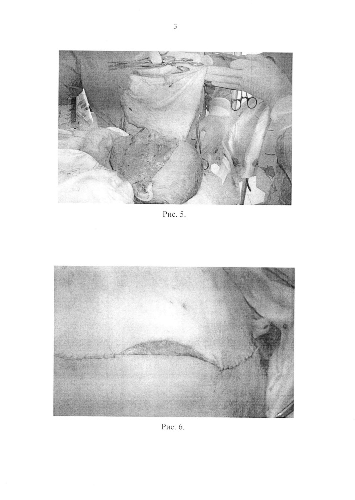 Способ хирургического лечения глубоких кожных дефектов (патент 2622979)