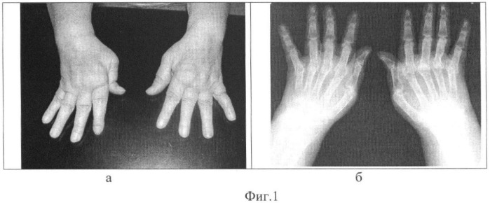 Способ реконструкции деформаций кисти при ревматоидном артрите (патент 2452422)