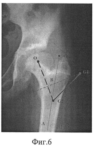 Способ лечения деформаций проксимального отдела бедра (патент 2528964)