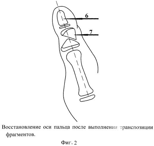 Способ оперативного лечения клинодактилии первого пальца кисти при акроцефалосиндактилии (патент 2546503)