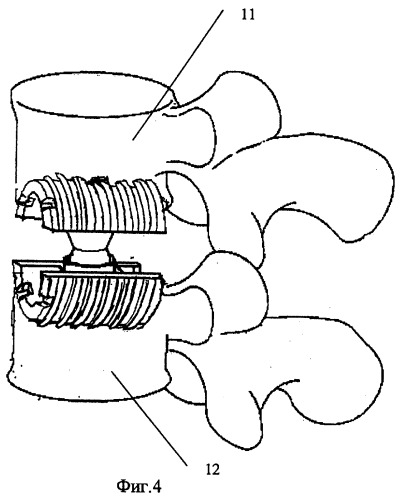 Эндопротез межпозвонкового диска (патент 2269324)