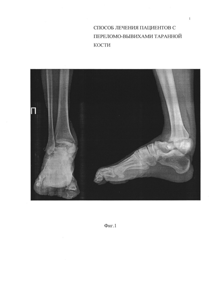 Способ лечения пациентов с переломо-вывихами таранной кости (патент 2659652)