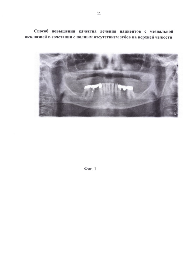 Способ повышения качества лечения пациентов с мезиальной окклюзией в сочетании с полным отсутствием зубов на верхней челюсти (патент 2658159)