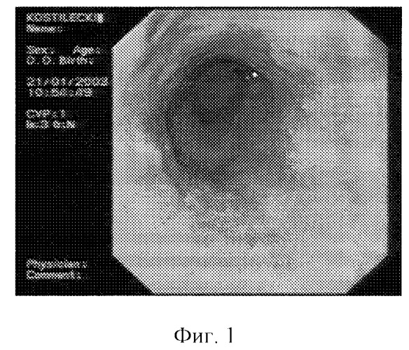 Способ дифференциальной диагностики степени рефлюкс-эзофагита (патент 2257149)