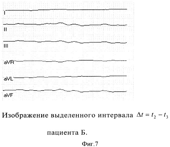 Способ выделения начала кардиоцикла (патент 2359606)