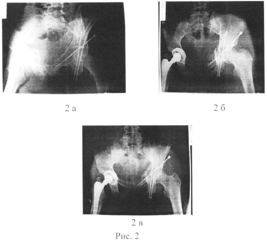 Способ хирургического лечения переломов вертлужной впадины (патент 2547803)