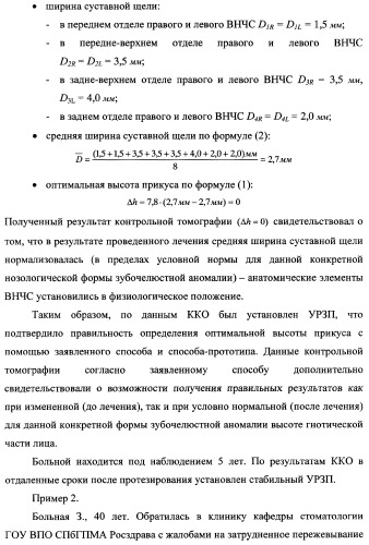 Способ определения оптимальной высоты прикуса (патент 2354300)