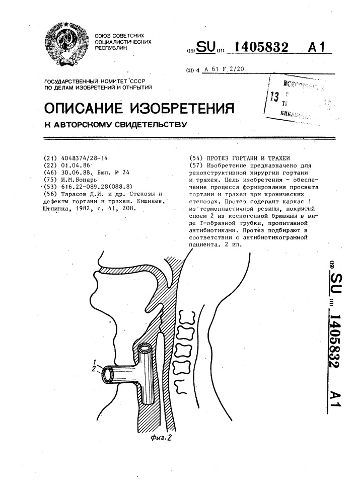 Протез гортани и трахеи (патент 1405832)