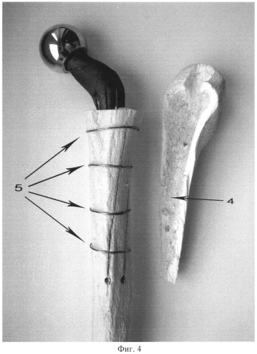 Способ остеотомии проксимального конца бедренной кости для установки и фиксации бедренного компонента эндопротеза тазобедренного сустава при врожденном высоком вывихе бедра (патент 2502487)