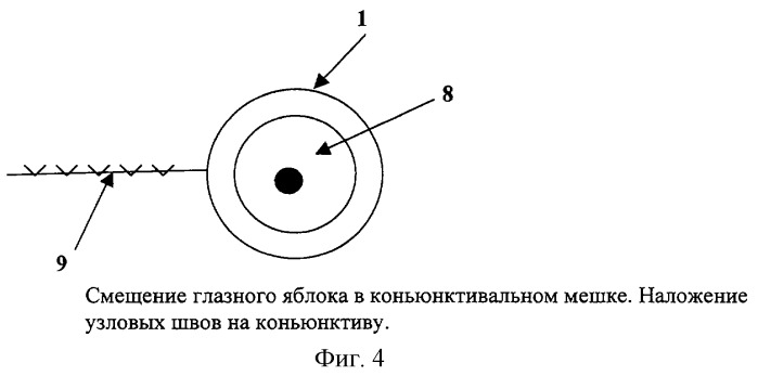 Способ лечения больших углов косоглазия (патент 2243750)